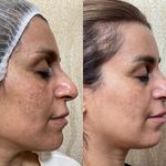 فیشال و پاکسازی. هایفو.پلاسماتراپی زهره