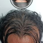 مریم درویشی میکرواسکالپ سر در اهواز