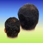 موسسه آموزش و درمان انواع ریزش مو ریشه