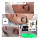 فیشیال و پاکسازی نگار