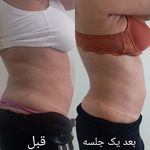 کلینیک تخصصی لاغری موضعی ولافیت
