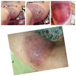 کارشناس و درمانگر زخم و وکیوم تراپی زخم