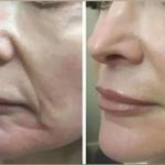 خدمات درمان جوش و لک ریزش مو کچلی مردانی