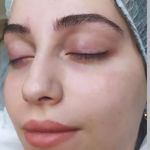 فیبروز تاتوبدن میکرواسکالپ نوشین مهاجر