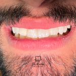 دندانپزشکی دکتر کاتبی کامپوزیت لمینیت