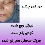 فیشیال و پاکسازی پوست