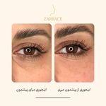 کلینیک تزریق فیلر و بوتاکس زرفیس