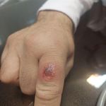 مطب عفونی وداخلی زگیل تناسلی زخم وریه