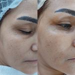 پاکسازی پوست وفیشال تخصصی فاطیما