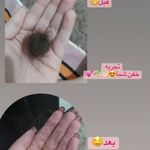 خدمات درمان جوش و لک ریزش مو کچلی مردانی