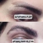 خدمات تخصصی ریموو  تتوی قدیمی