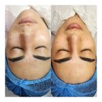 فیشیال و پاکسازی پوست مریم