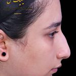 عمل بینی ملل کلینیک
