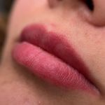 میکروبلیدینگ عسل علیزاده