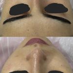 خدمات درماپلنینگ vip با اصلاح ابروی رایگان