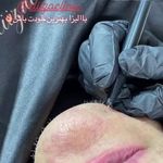 کلینیک تخصصی پوست و مو لیزر‌موهای زائد الیزا