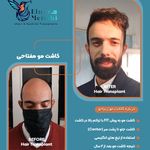 کاشت مو مفتاحی