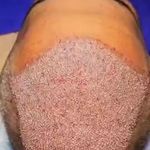 کلینیک تخصصی کاشت موی پرنیان