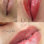 مرکز میکروبلیدینگ شیدینگ ریموو اسکالپ