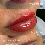 میکروکیماسی( میکروابرو چشم لب،ریمو)