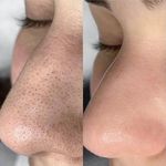 خدمات فیشیال پوست حانیه