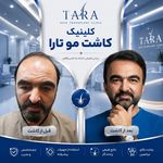 کاشت مو و ابرو