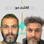 کلینیک تخصصی پوست و کاشت مو آوا