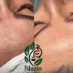 پاکسازی و فیشال صورت نازین