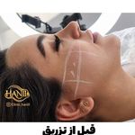 کلینیک هانیل | فیلر و بوتاکس شرق
