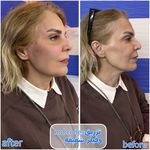 برفین اسکین