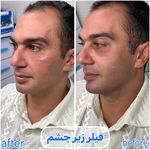 برفین اسکین