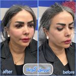 برفین اسکین