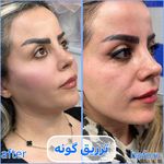 برفین اسکین