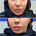 برفین اسکین