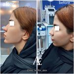 برفین اسکین