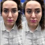 برفین اسکین