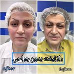 برفین اسکین