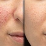 پاکسازی تخصصی پوست تارا ( فیشال تخصصی)