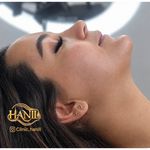 کلینیک هانیل | فیلر و بوتاکس شرق