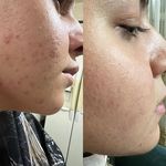 فشیال و پاکسازی تخصصی پوست