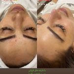 خدمات فیشیال و پاکسازی پوست