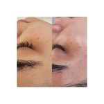 پاکسازی پوست و انواع فیشال تخصصی