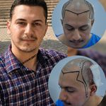 کاشت مو به روش سوپرمیکروگرفت