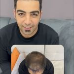 کلینیک کاشت مو زمرد
