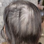 میکرو، شیدینگ لب ریموو تتو میکرواسکالپ ندا