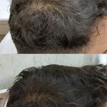 موسسه آموزش و درمان انواع ریزش مو ریشه