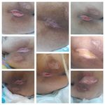 کارشناس زخم و متخصص کیوم تراپی بهرامی فر