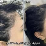کلینیک تخصصی کاشت موی پرنیان