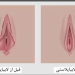 لابیوپلاستی و زیبایی زنان در غرب تهران