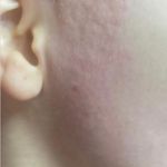 خدمات الکترولیز موهای زائد شاینا